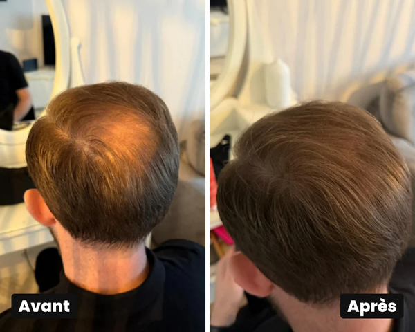 Avant / Après de Lucas L.